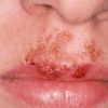 Father’s Cold Sore Misdiagnosed as Impetigo Leads to Daughter's Health Complications in Spain