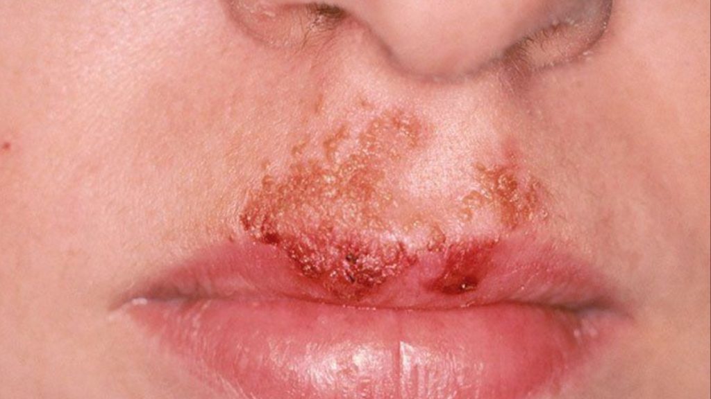 Father’s Cold Sore Misdiagnosed as Impetigo Leads to Daughter's Health Complications in Spain