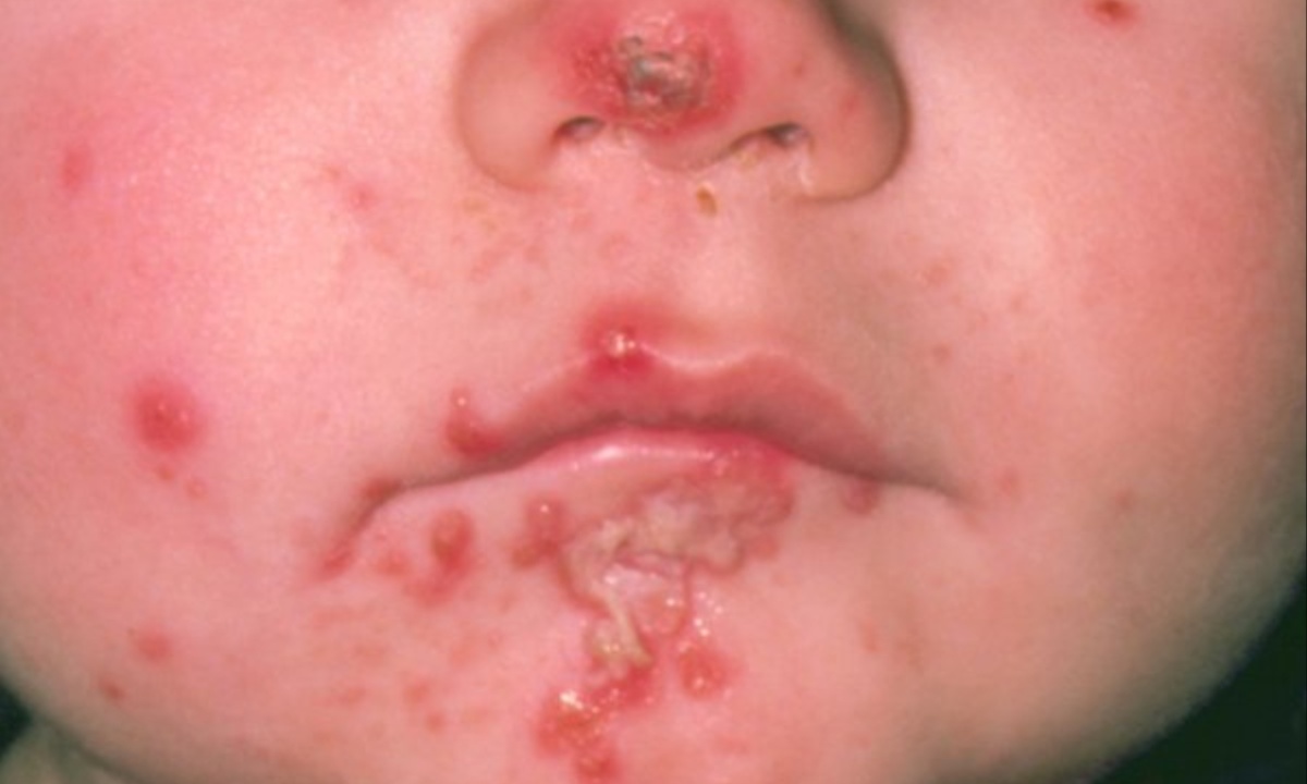 Father’s Cold Sore Misdiagnosed as Impetigo Leads to Daughter's Health Complications in Spain