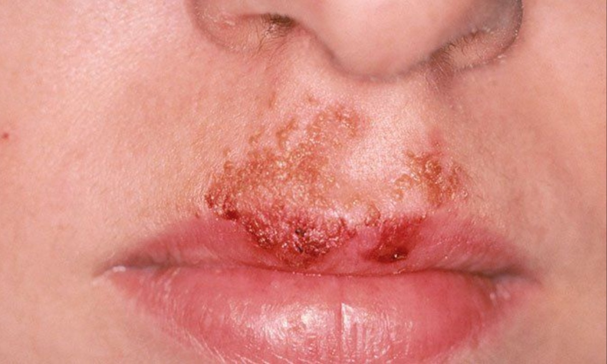 Father’s Cold Sore Misdiagnosed as Impetigo Leads to Daughter's Health Complications in Spain